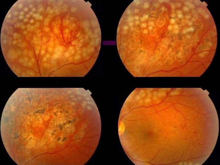 Hipertensijas izraisīta retinopātija
